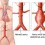 What are the symptoms of aortic aneurysm?