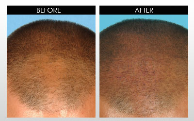 Download Derma Roller For Hair Loss PNG