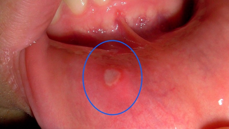 The Mouth Ulcer Home Treatment