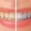 Top 5 Home Teeth Whitening Methods